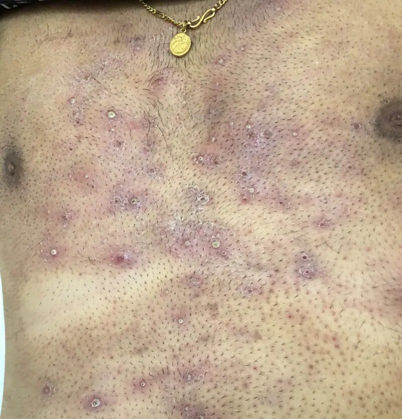 면도한 가슴의 털구멍을 중심으로 농포가 보이는 모낭염 실제 사진