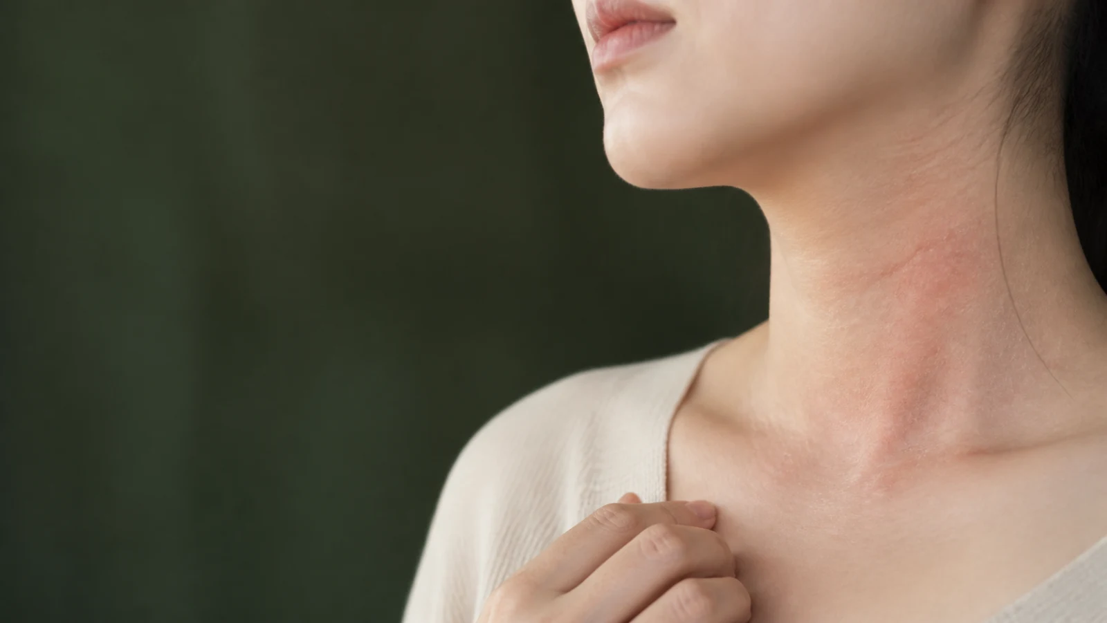 턱 아래와 목 주름에 건조하고 붉은 습진성 병변이 보이는 성인의 부분 모습
