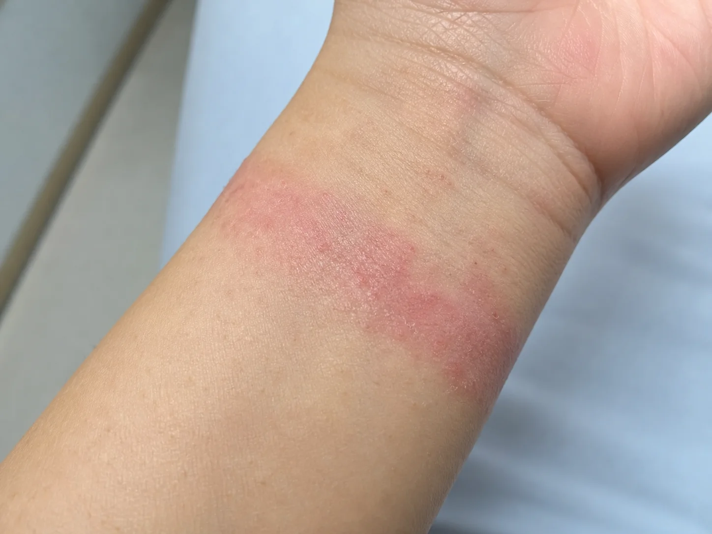 손목에 밴드가 닿은 듯한 띠 모양의 붉음과 잔각질이 보이는 접촉피부염 교육용 근접 예시