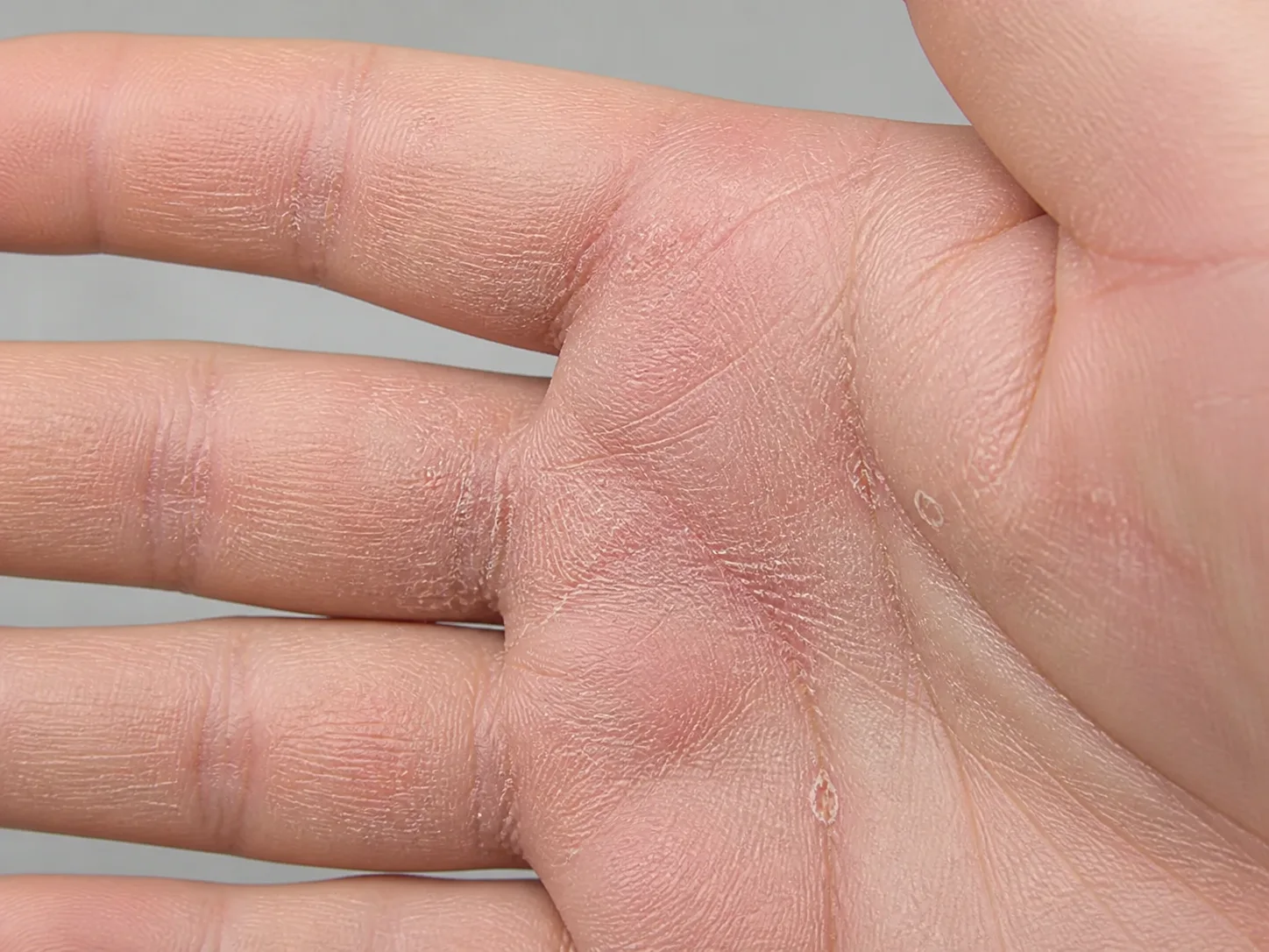 손바닥에 마른 수포 자국의 둥근 박리와 얕은 균열, 옅은 붉음이 남은 만성 재발 한포진 교육용 예시